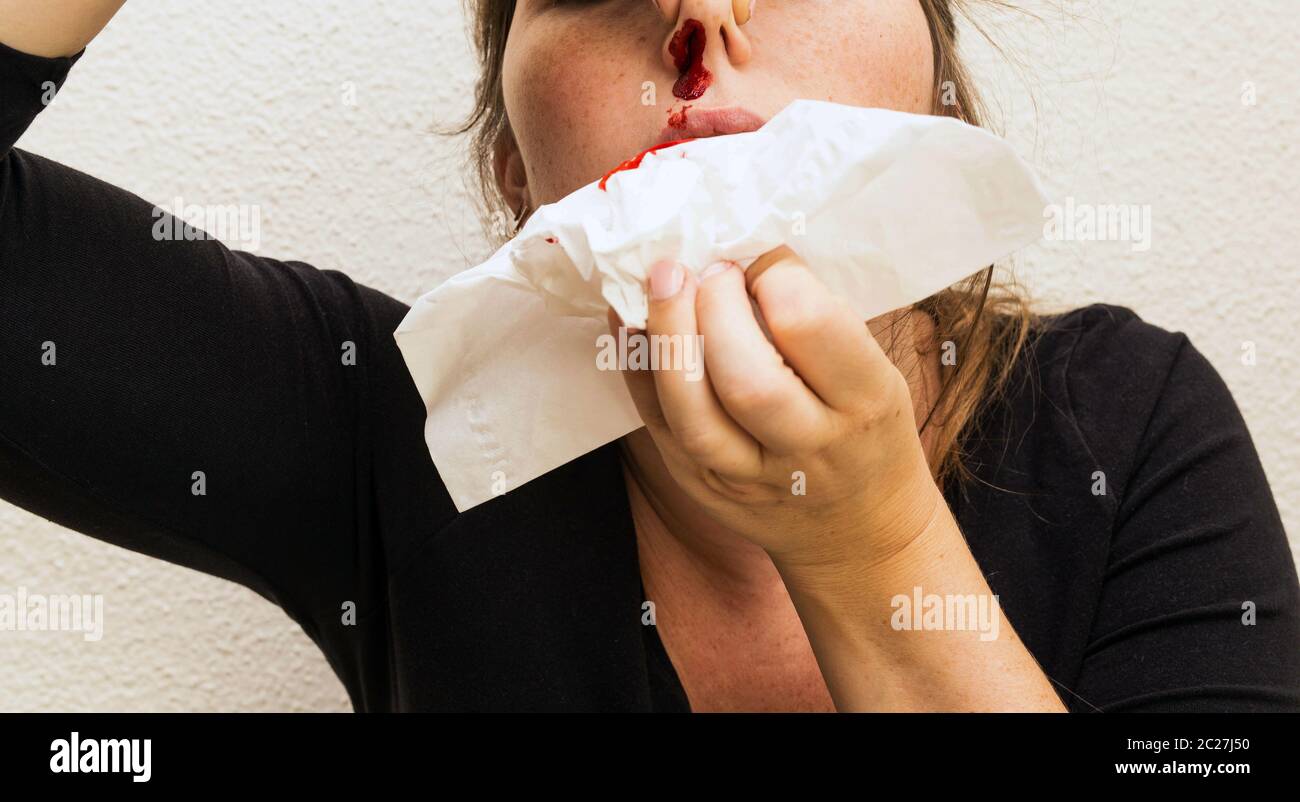 Wound nosebleed, woman bleeding from her nose, nose injury blood and