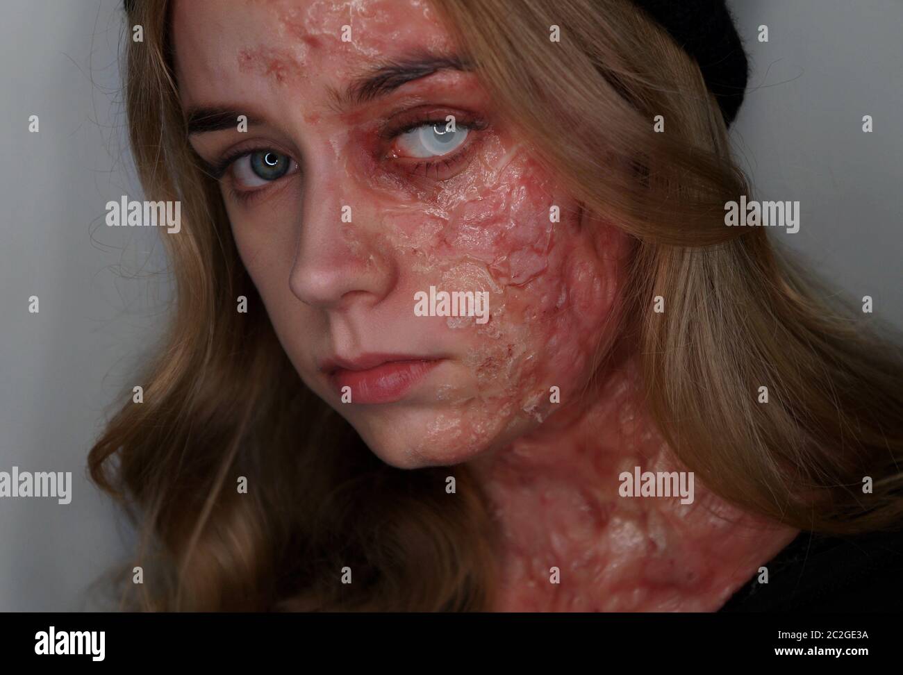 Burnt face hi-res stock photography and images - Alamy