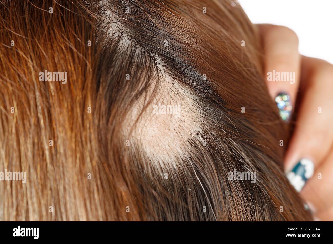 30 year old Caucasian woman with spot alopecia, bald spot on her head Stock Photo