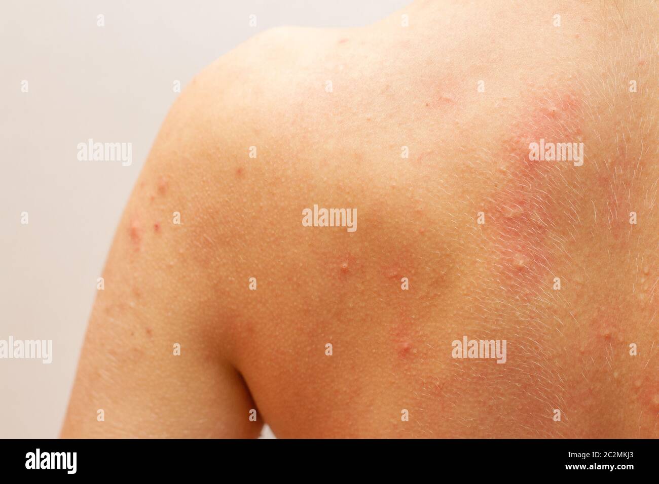 urticaria allergy on skin back Stock Photo Alamy