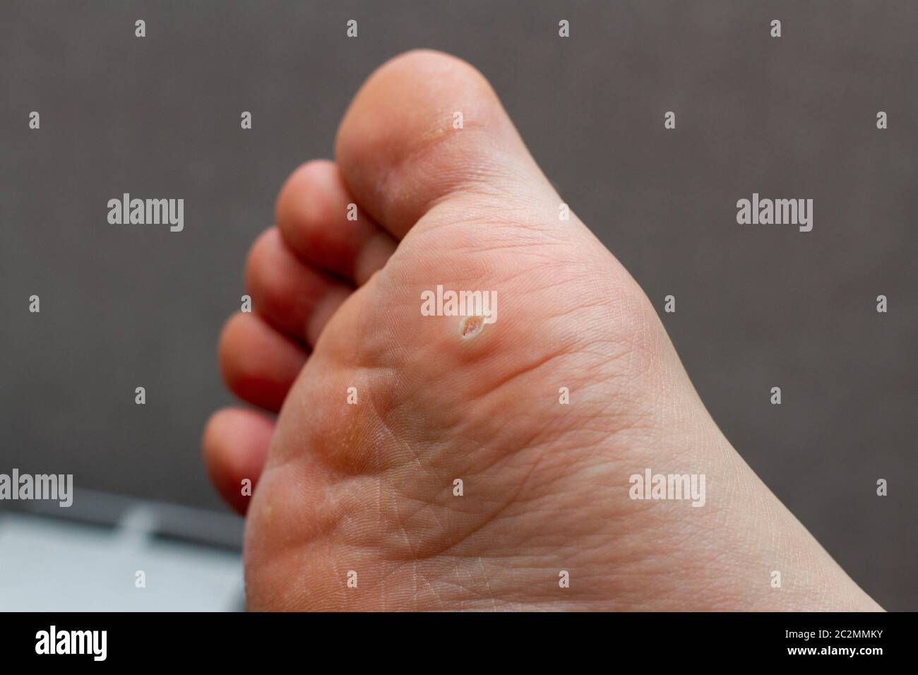Wart on the foot. Plantar wart on the foot, close up Stock Photo Alamy