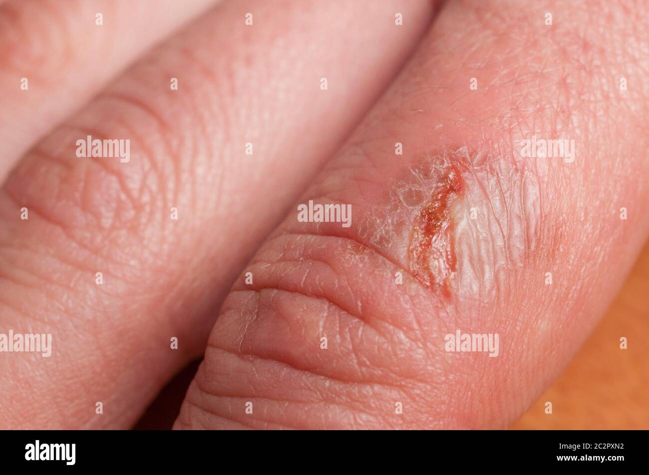 Burn Blister Hand High Resolution Stock Photography And Images Alamy