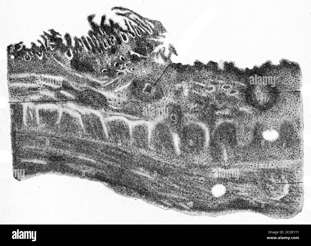 Margin of tubercular ulcer of the intestine, vintage engraved illustration. Stock Photo