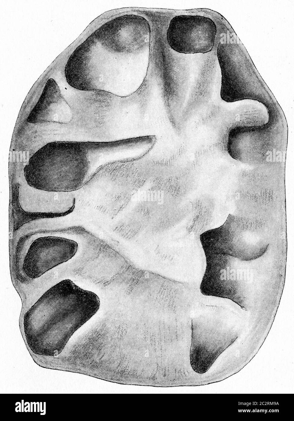 Tuberculous pyelonephritis, chronic ascending tuberculosis of the kidney, vintage engraved illustration. Stock Photo