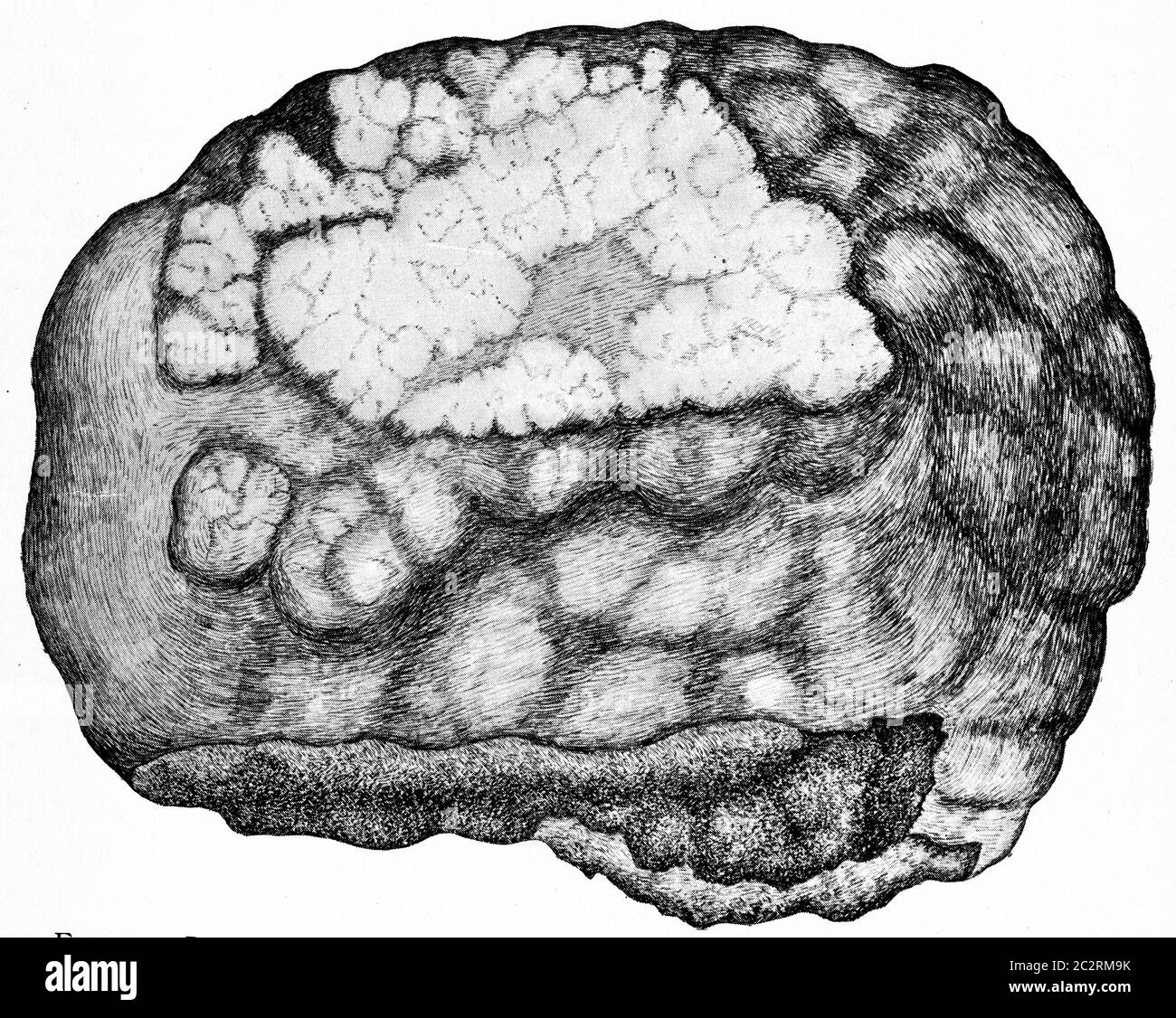Part of left lobe of the liver, showing primary cylindric cell carcinoma, vintage engraved illustration. Stock Photo