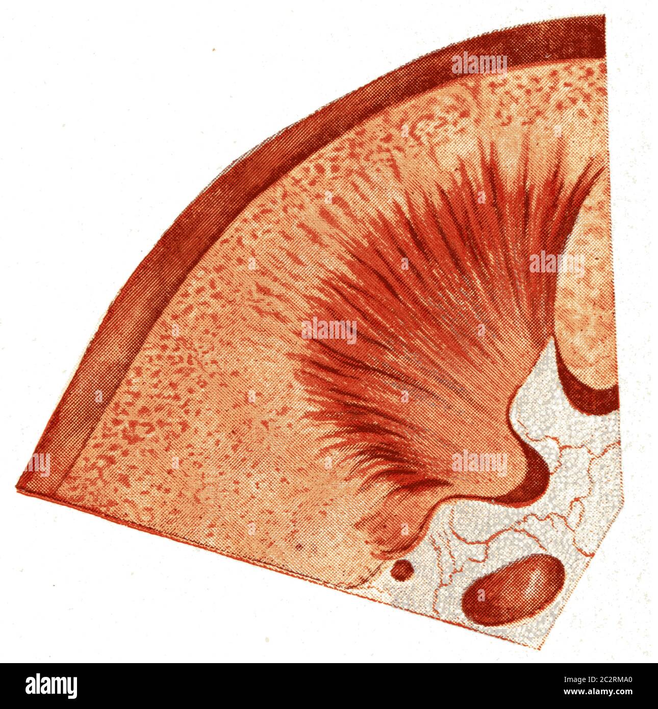 Kidney, acute parenchymatous nephritis, vintage engraved illustration. Stock Photo