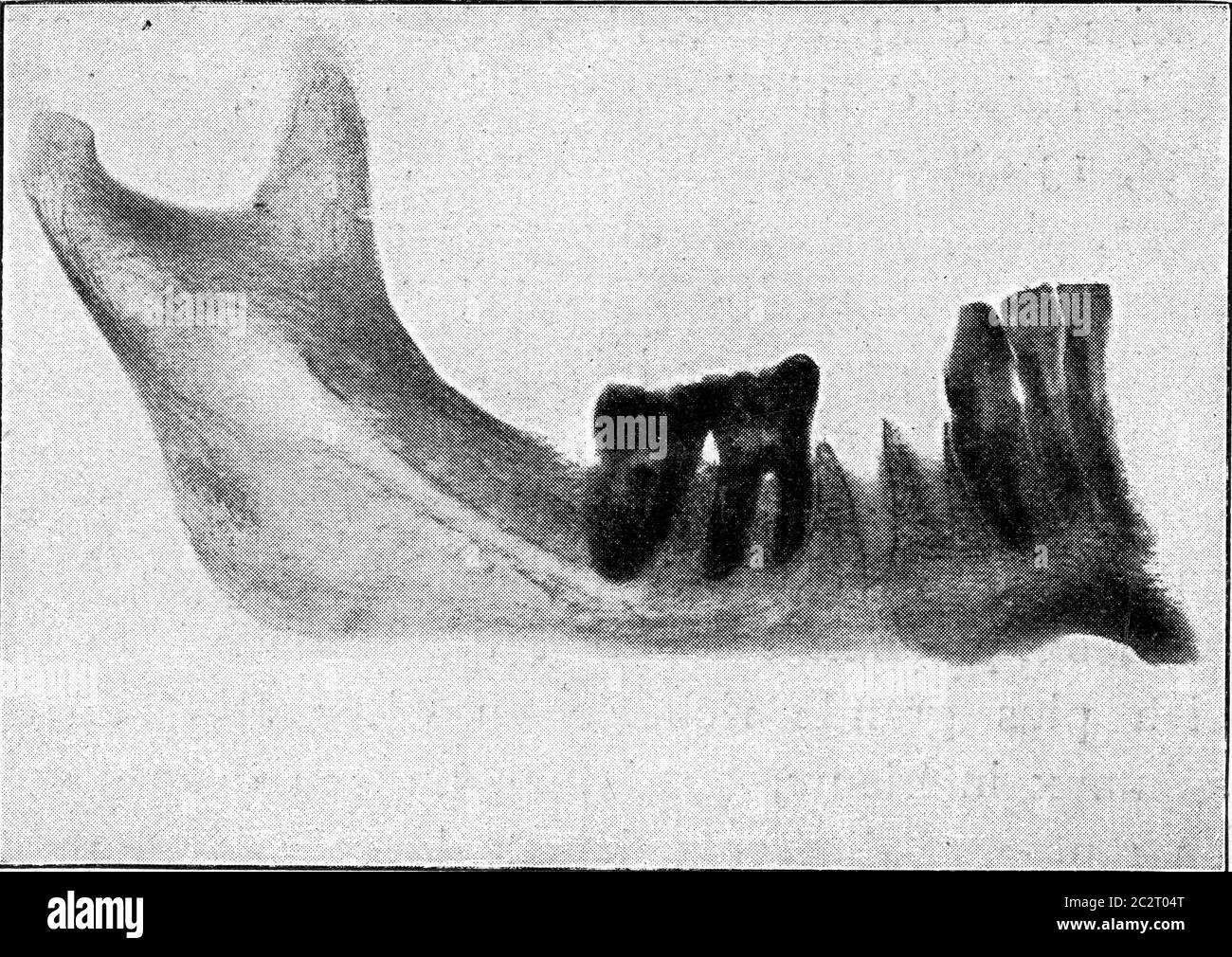 Lower human body, in which the third molar has not reached its development, vintage engraved illustration. From the Universe and Humanity, 1910. Stock Photo