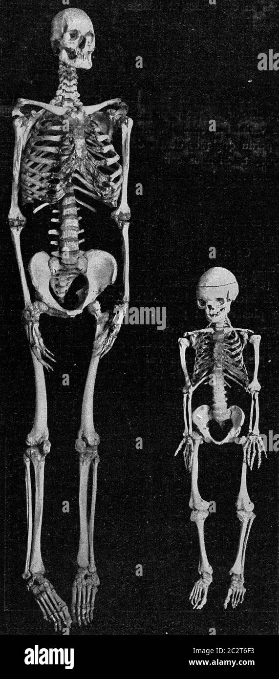 Skeleton of a giant and a dwarf, vintage engraved illustration. From the Universe and Humanity, 1910. Stock Photo
