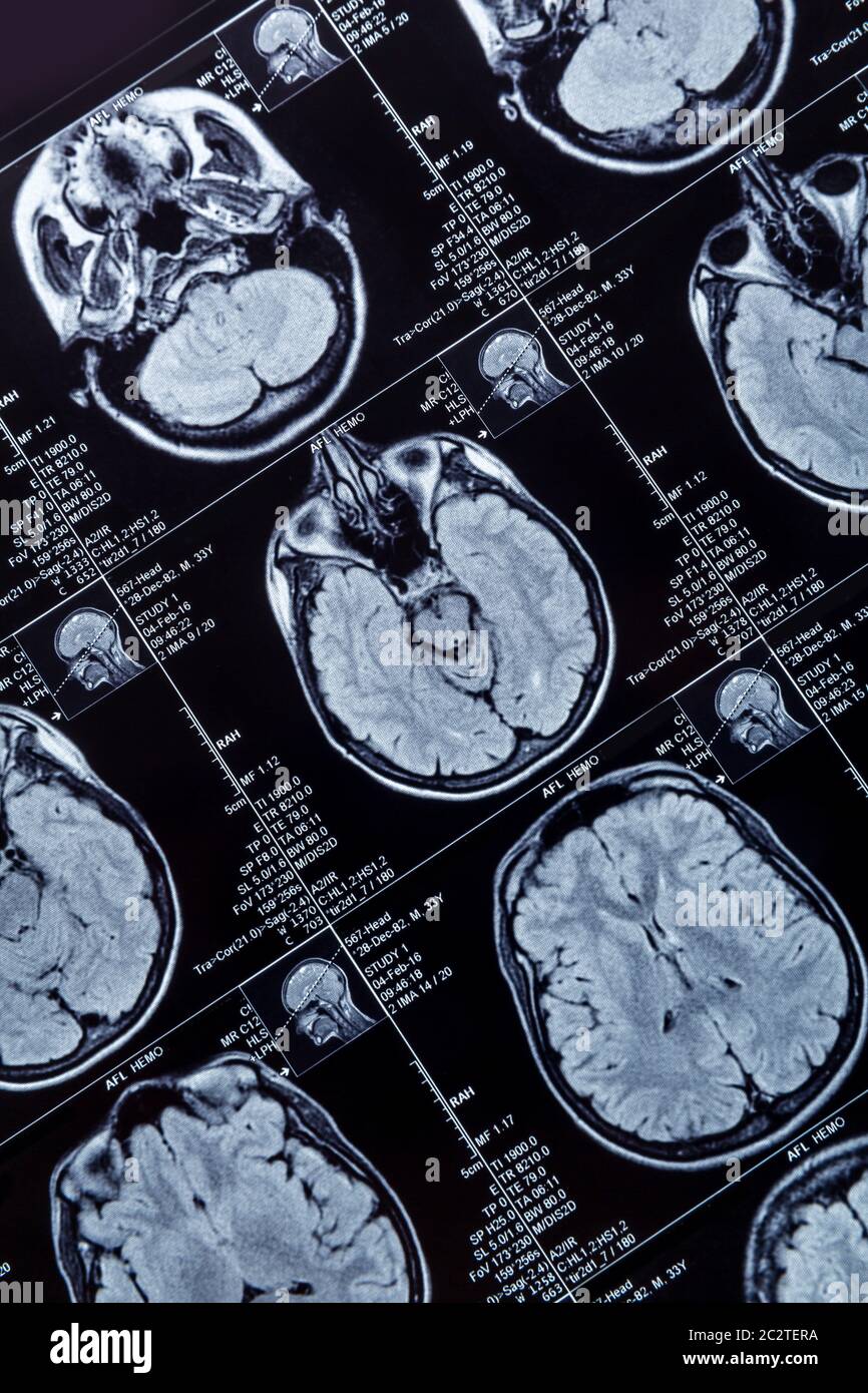 resonance imaging photography of human brain closeup Stock