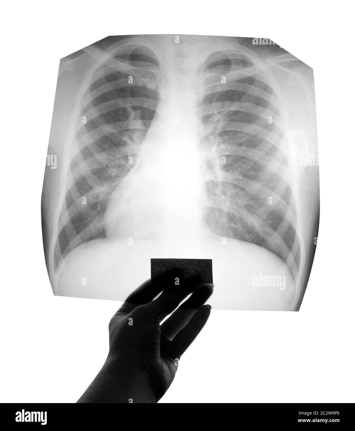 Chest X-ray image in hand Stock Photo