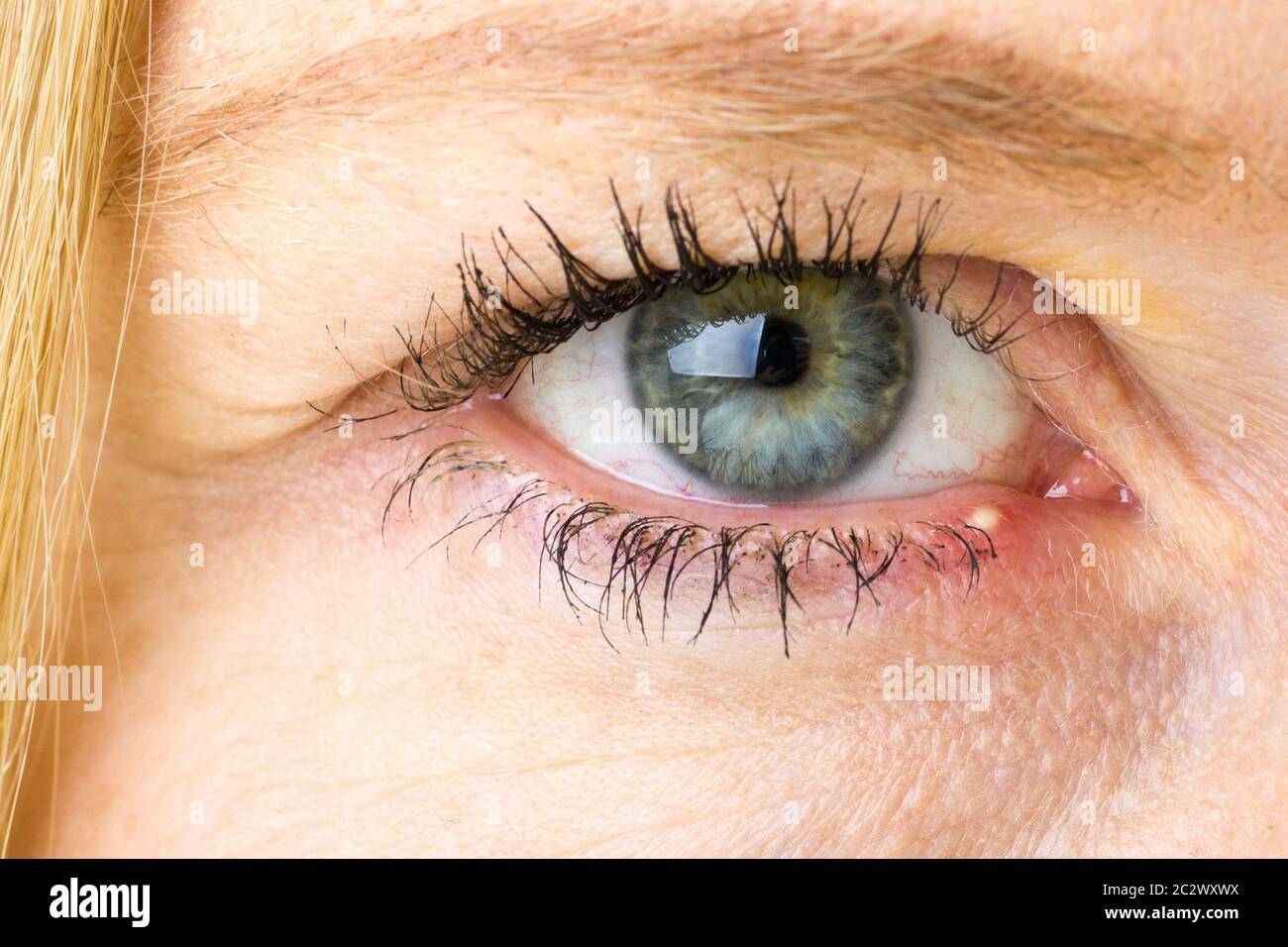 Stye, Hordeolum, bacterial infection of womans eye, medical, pharmaceutical, eye concepts Stock Photo