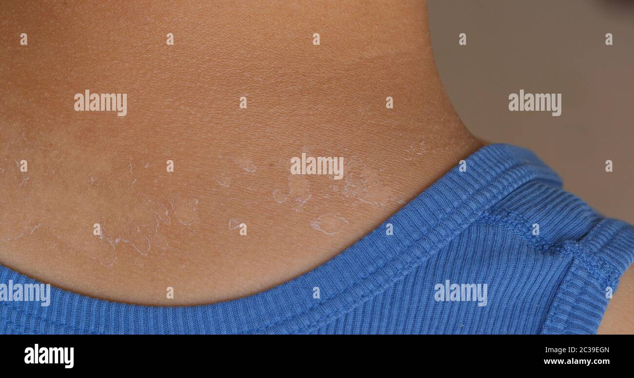 Sunburned sunburn peeling skin hires stock photography and images Alamy