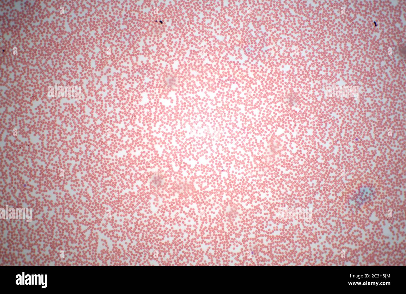 Microscope slide smear sample of human blood cells Stock Photo