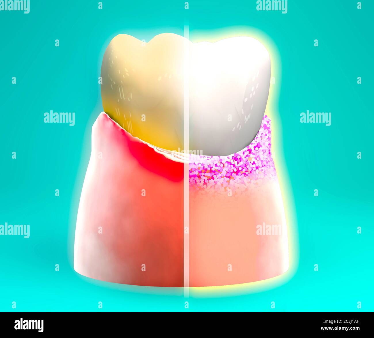 Tooth, sore gum, redness, dentistry, dental cleaning, oral hygiene