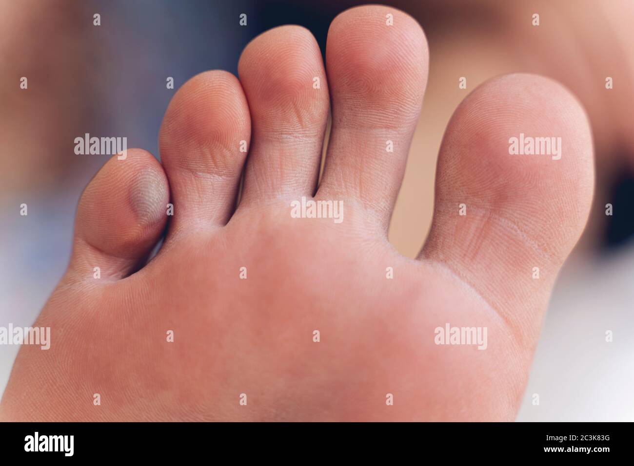 the-many-types-and-causes-of-foot-blisters-blister-44-off
