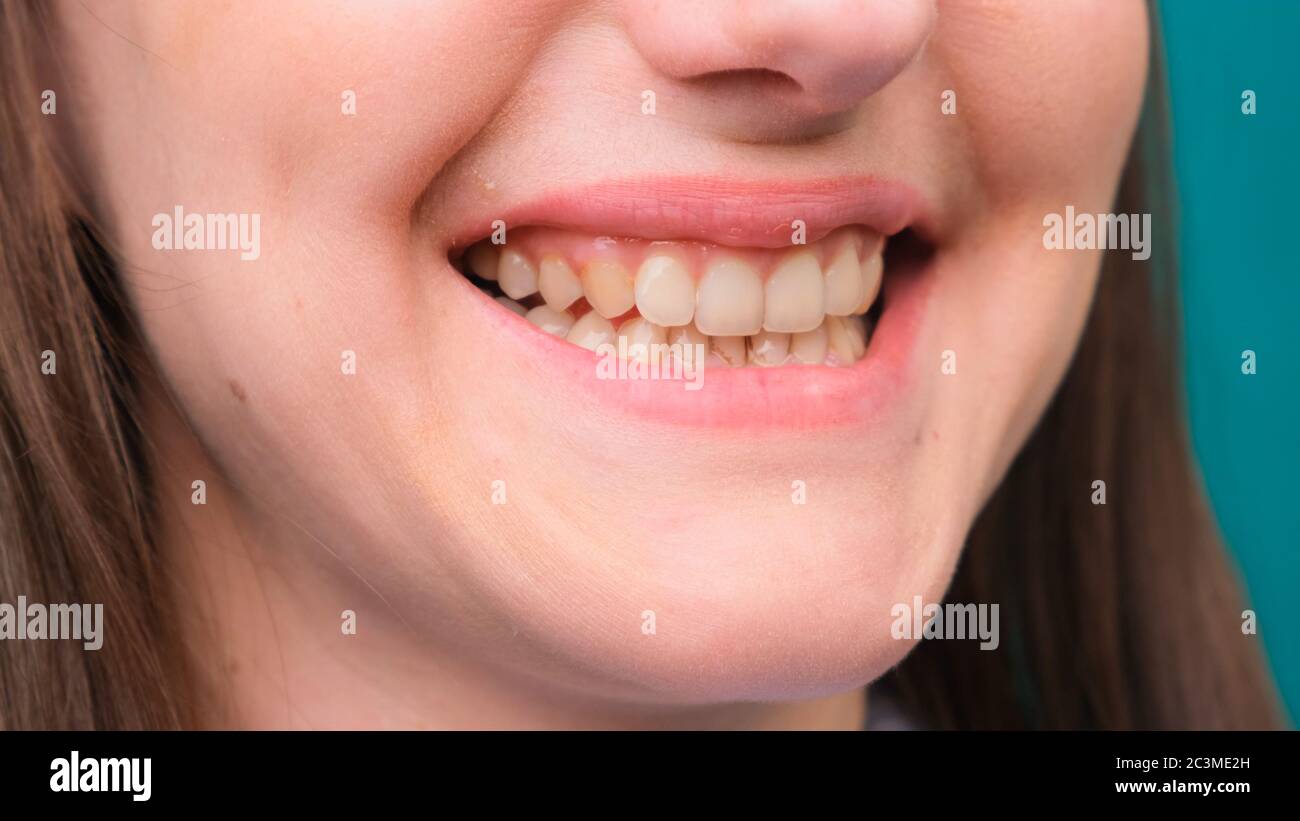 female Yellow teeth, fluorosis. Smokers problem teeth caused by