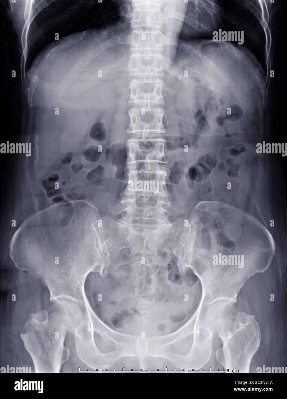 Abdominal X Ray Anatomy