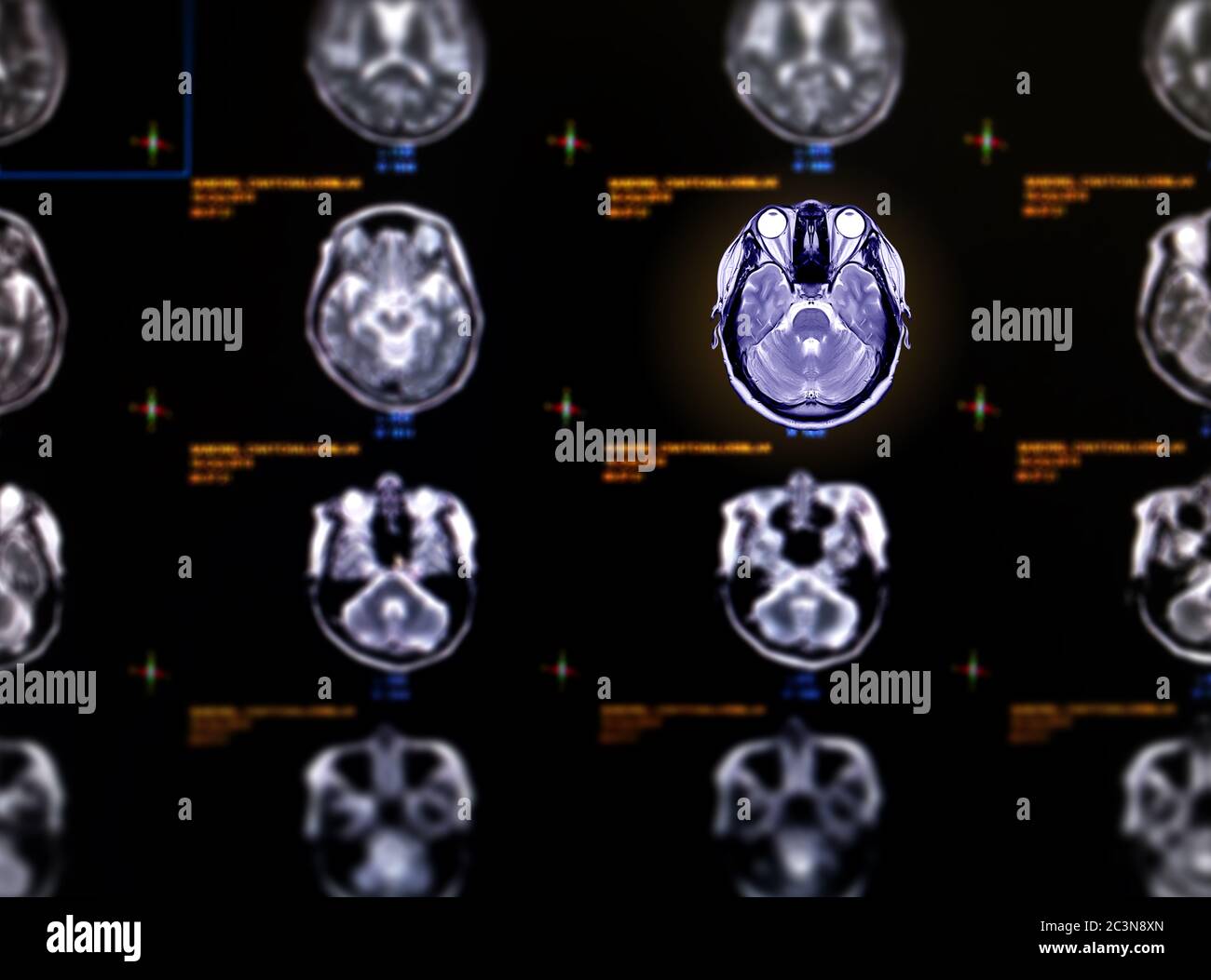 Selective focus of MRI brain axial view for detect a variety of