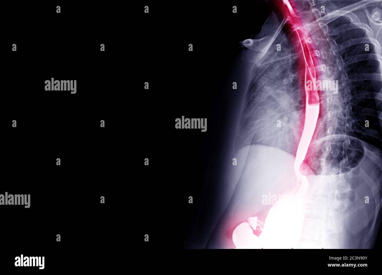 Esophagram or Barium swallow oblique view  for backdrop medical concept. Stock Photo