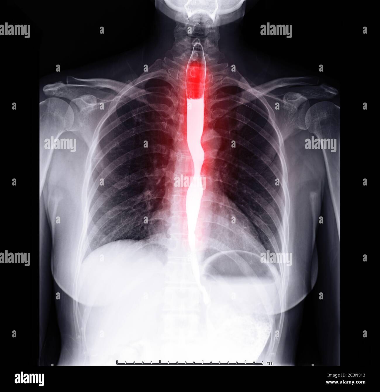 Esophagram or Barium swallow Front view  showing esophagus for diagnosis GERD or Gastroesophageal reflux disease Stock Photo