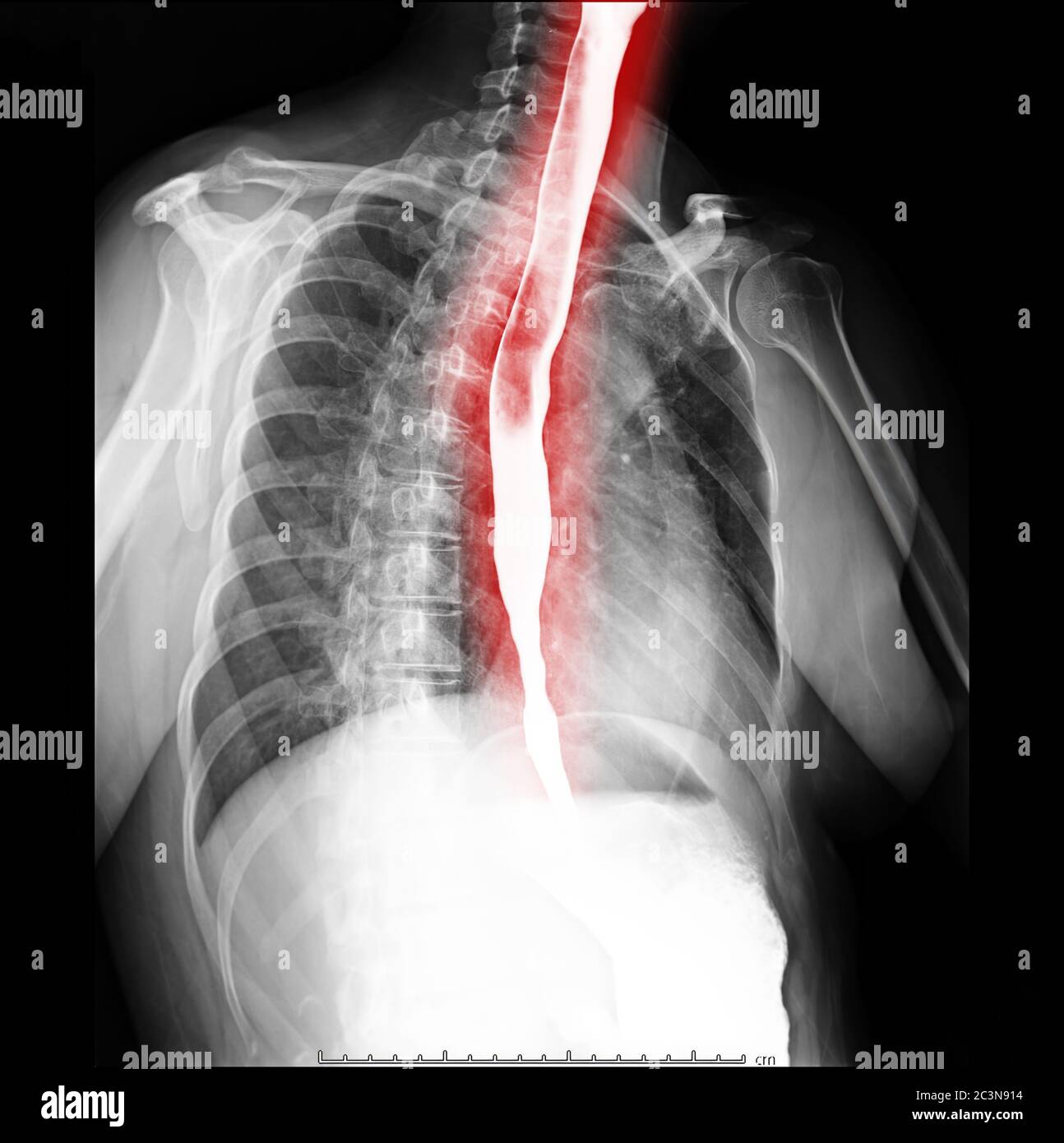Esophagram or Barium swallow oblique view  showing esophagus for diagnosis GERD or Gastroesophageal reflux disease Stock Photo