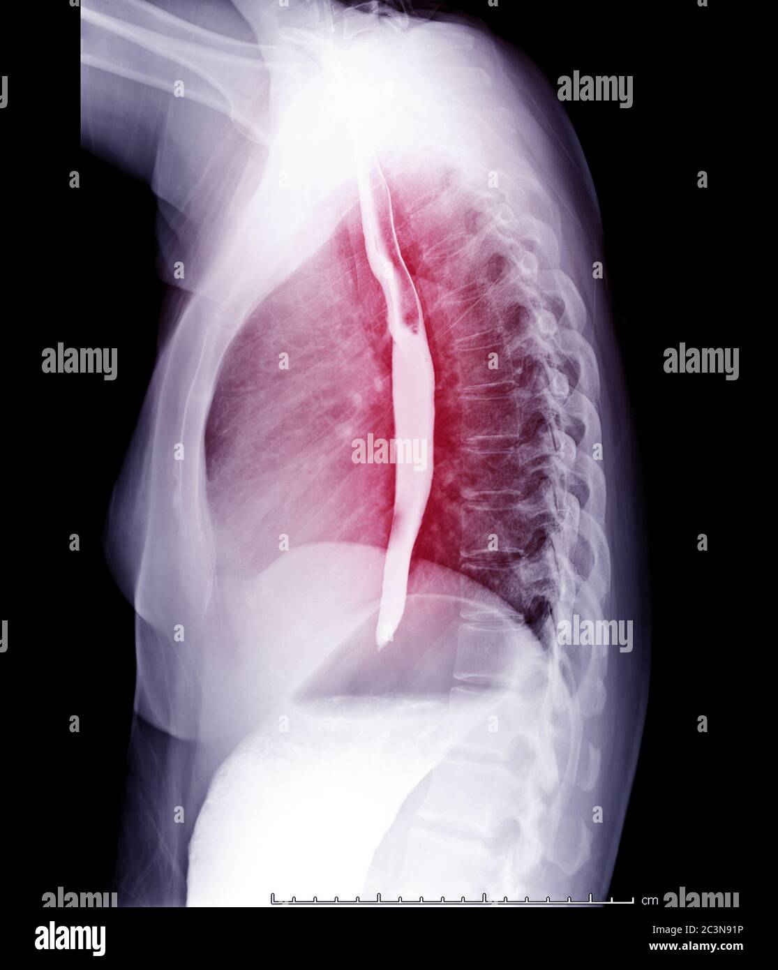 Esophagram or Barium swallow Lateral view  for diagnosis GERD or Gastroesophageal reflux disease. Stock Photo