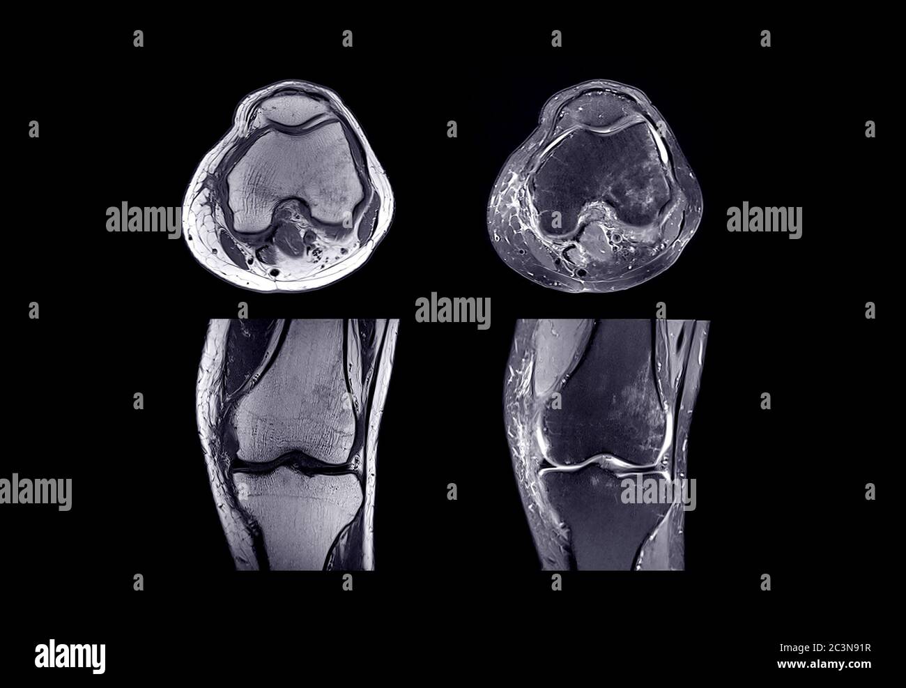 MRI knee joint or Magnetic resonance imaging comparison Axial and coronal view. Stock Photo