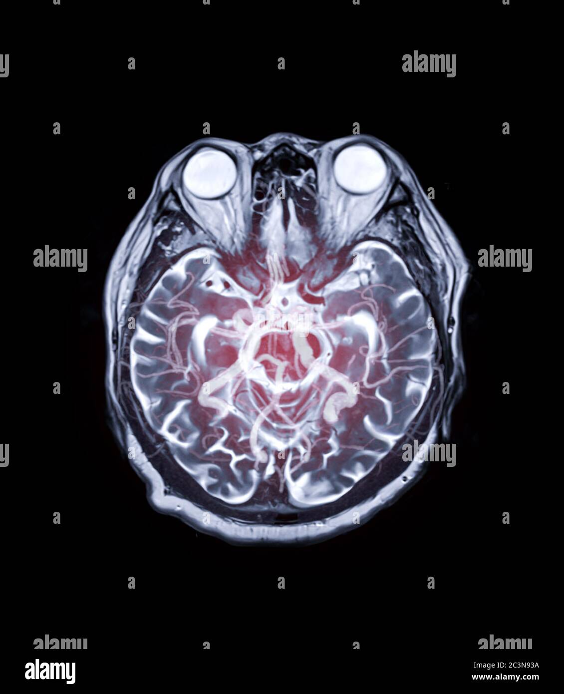 MRI brain Axial T2 technique with mra brain mix image for background ...