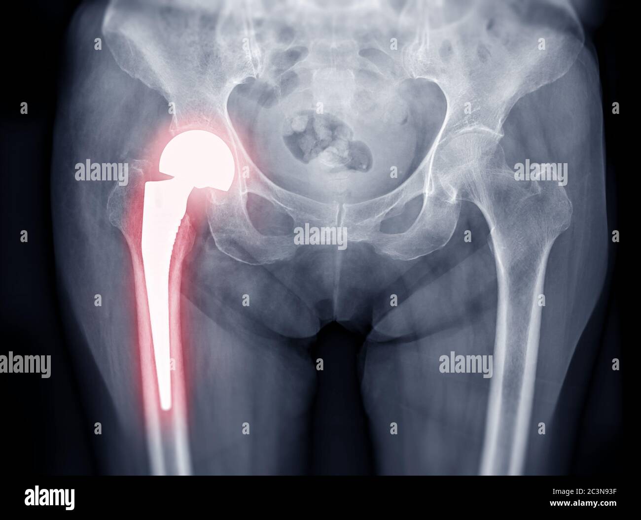 x-ray Both hip  ap view showing Right hip replacement or hip prosthesis made from titanium. Stock Photo