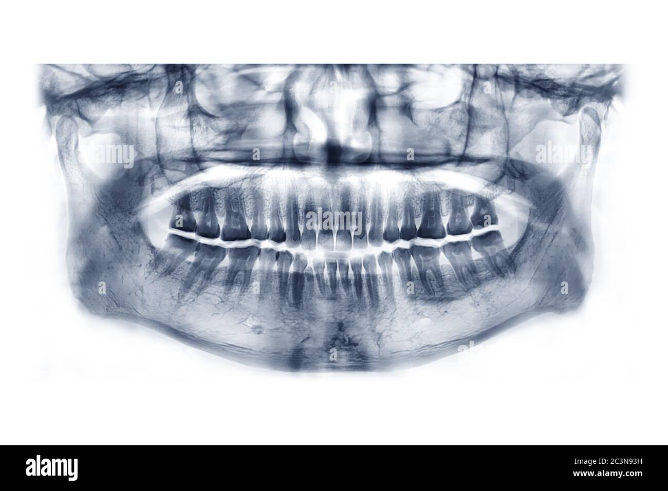 Panoramic dental xray image or orthopantomogram of jaw with all teeth