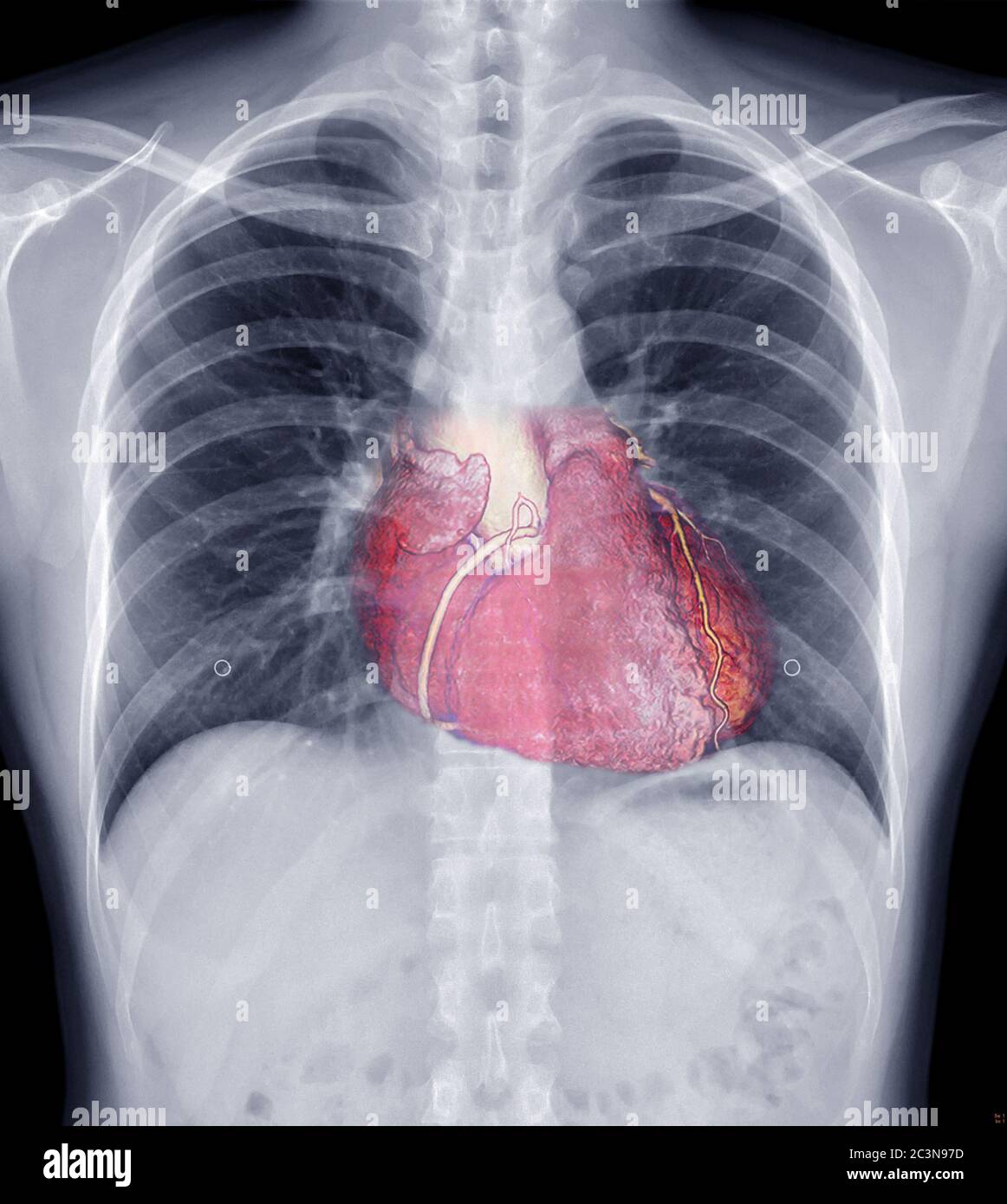Mix Chest X-ray and 3D CTA Coronary arery Image showing heart inside ...