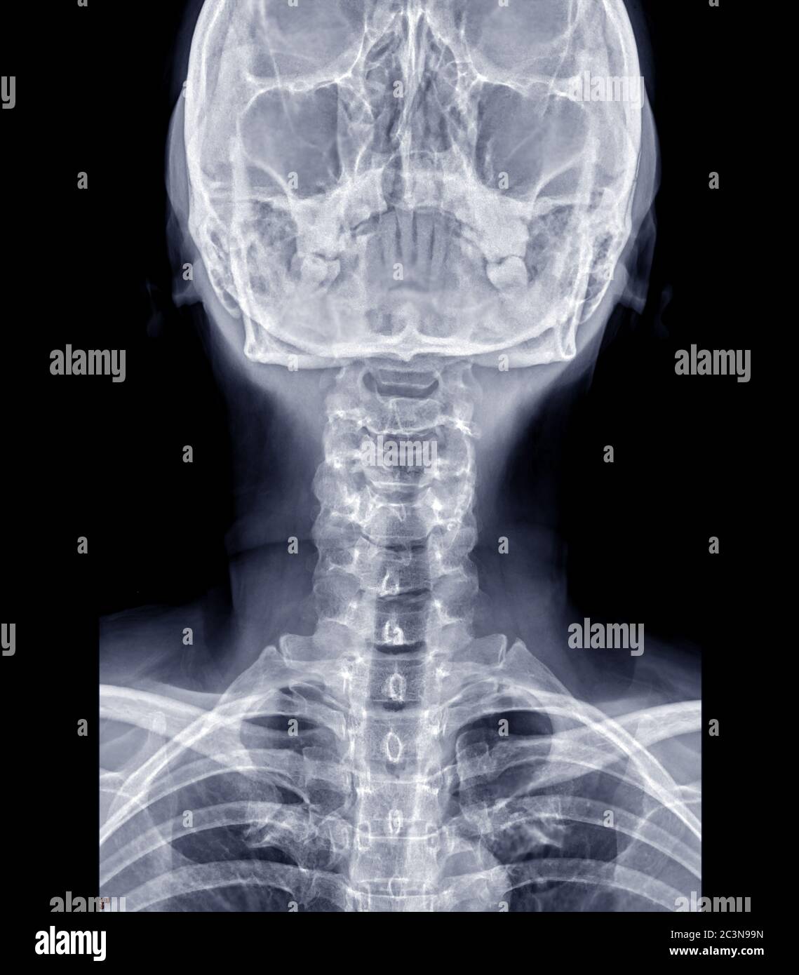X-ray C-spine or x-ray image of Cervical spine AP  view for diagnostic intervertebral disc herniation. Stock Photo