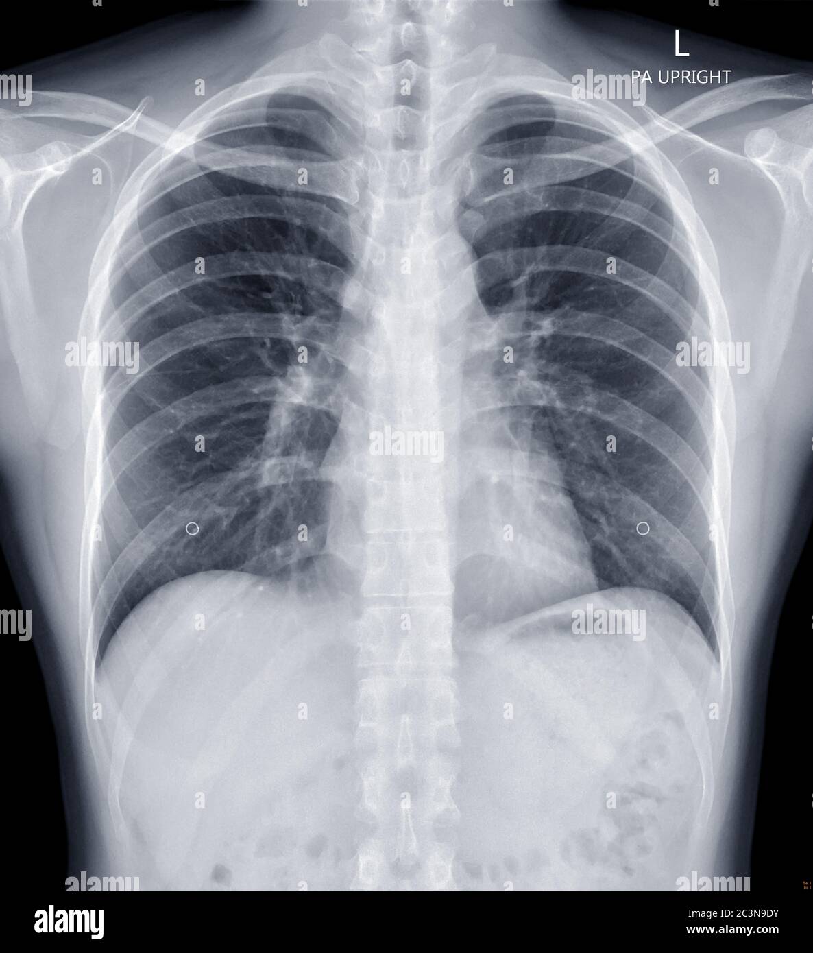 Chest Xray or XRay Image Of human Chest for diagnosis tuberculosis