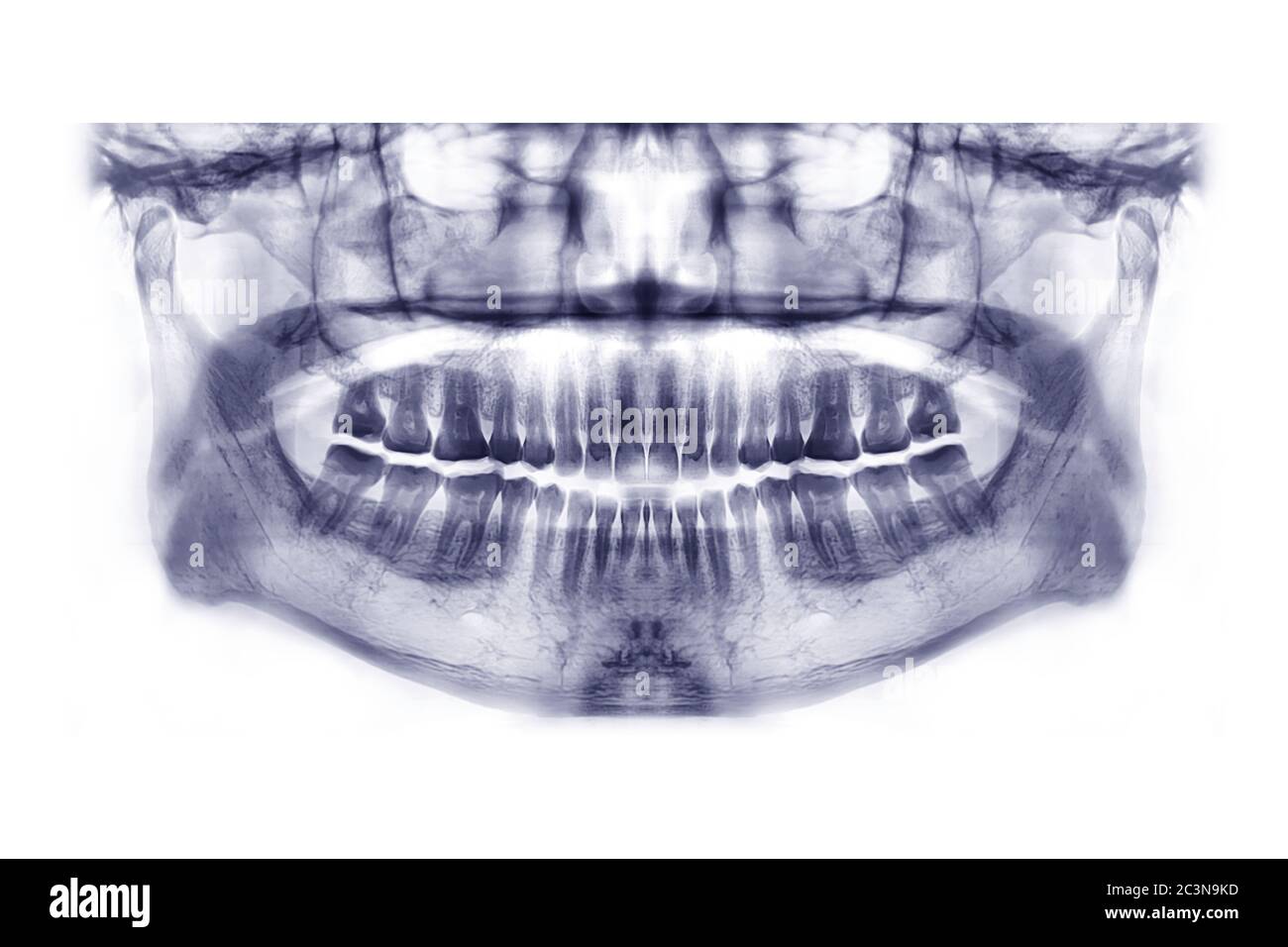 Jaw x ray Cut Out Stock Images & Pictures Alamy