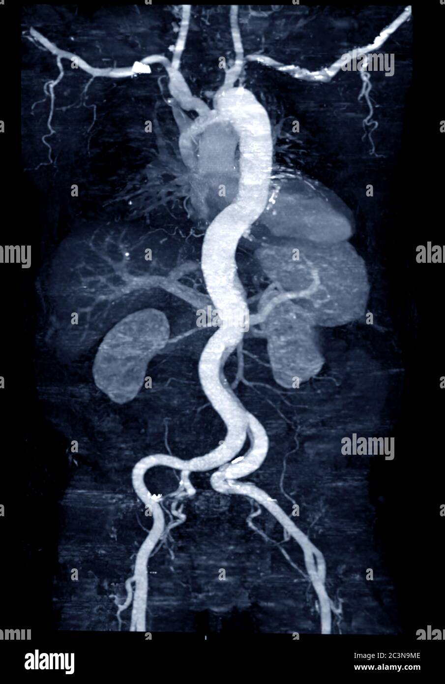 CTA whoe aorta with curve MPR technique showing abdominal aorta and left, right iliac artery showing aortic dissection . Stock Photo