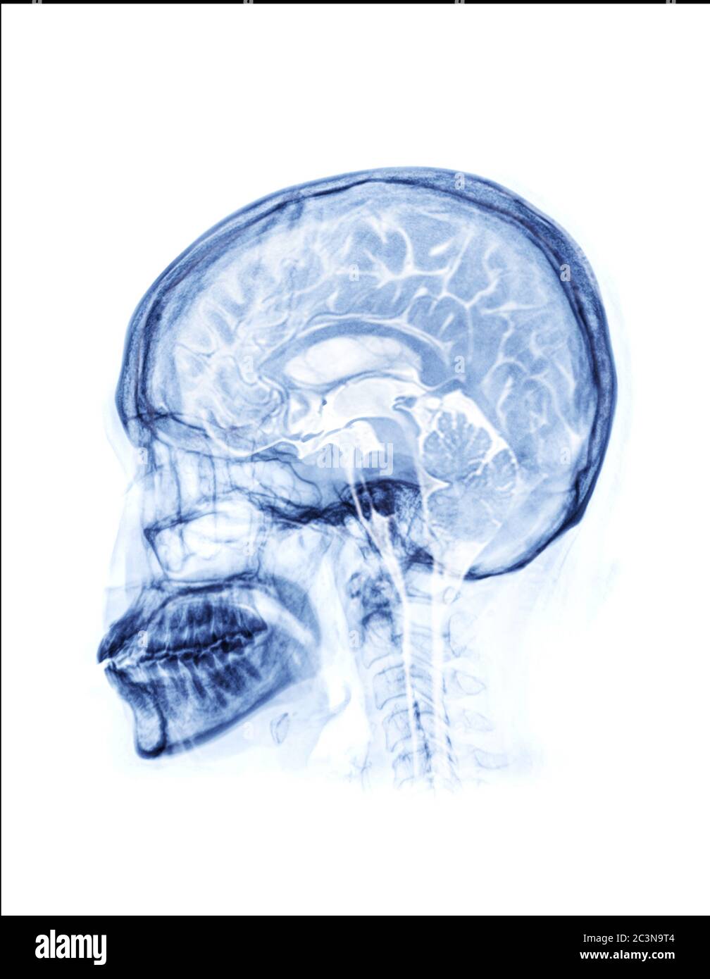 Skull x-ray lateral view with merge MRI brain sagittal view for medical background concept. Stock Photo