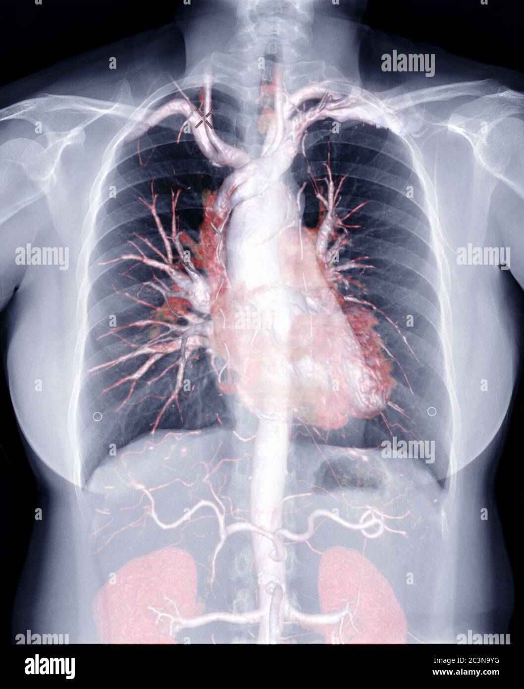 Chest X-ray with 3D rendering image CTA whole aorta inside the chest. Stock Photo