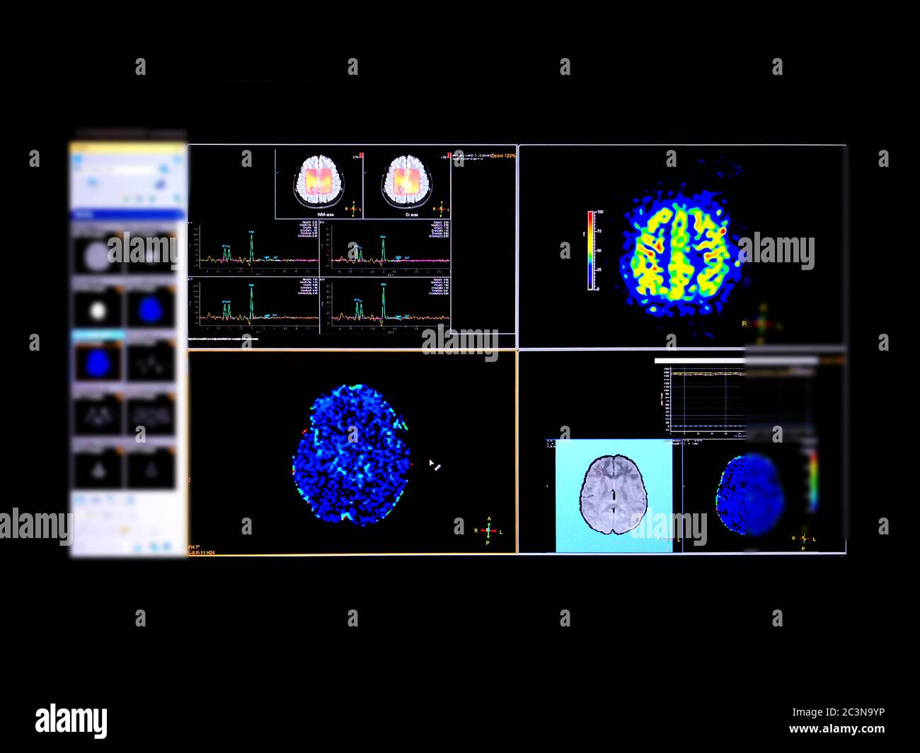 Magnetic Resonance (MR) spectroscopy of the brain for  identifies the anatomical location of a tumor. Stock Photo