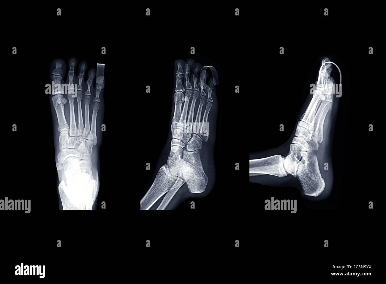 Comparison of X-ray Right foot image AP , oblique and lateral view with ...