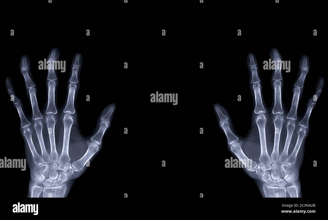 Ap Hand xray image of both hand AP view isolated on black background for ...