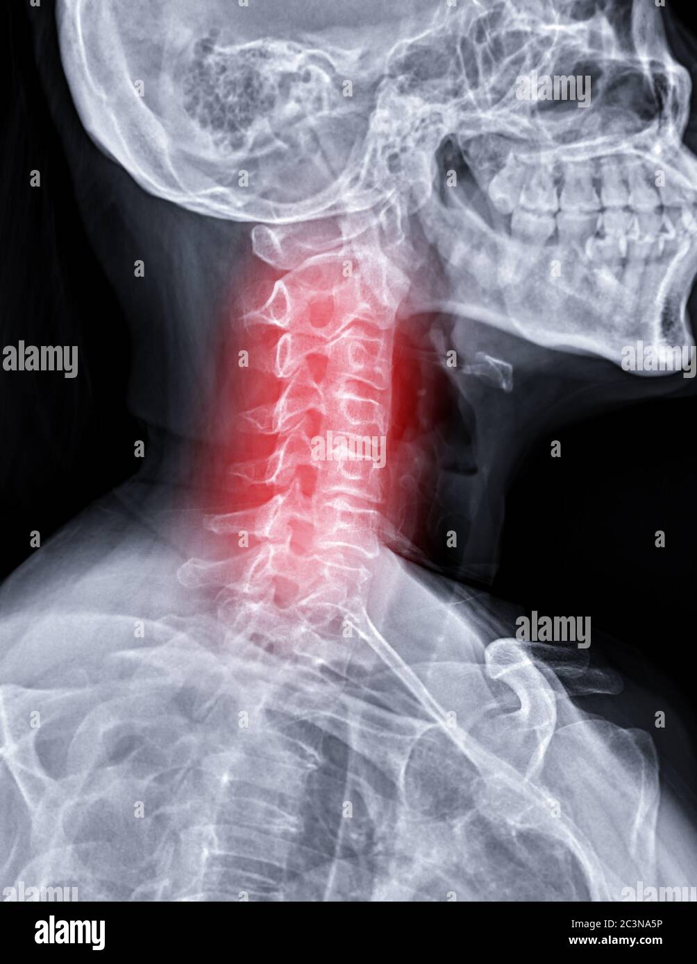 X-ray C-spine or x-ray image of Cervical spine oblique view for diagnostic intervertebral disc herniation. Stock Photo