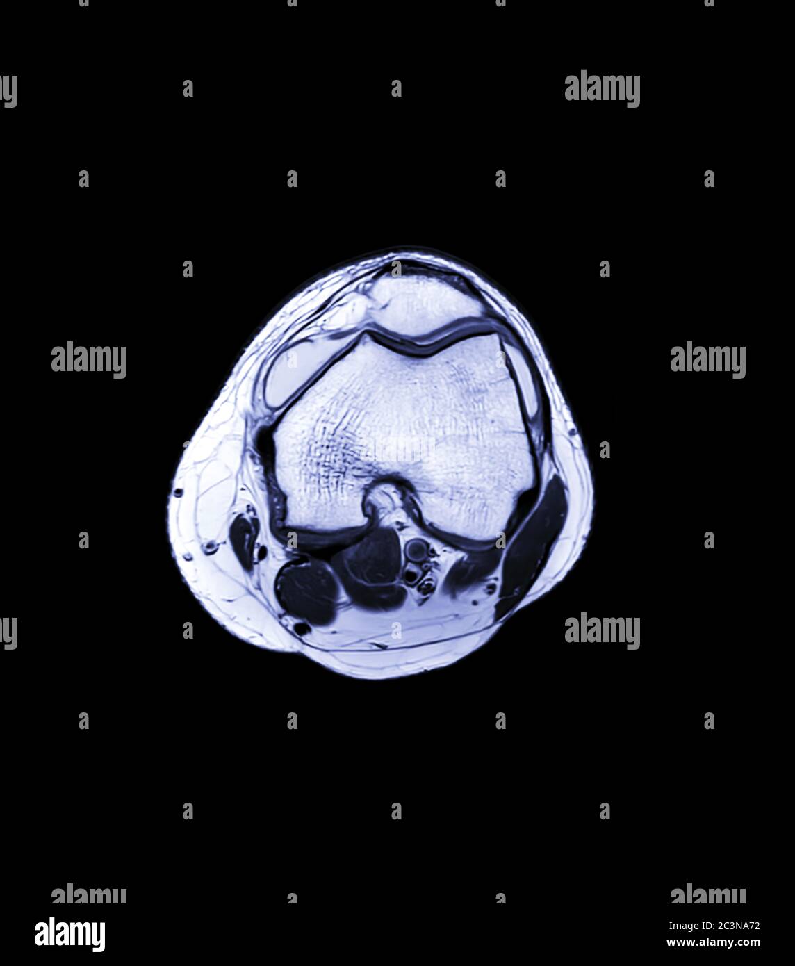 MRI Knee joint or Magnetic resonance imaging axial for detect tear or ...