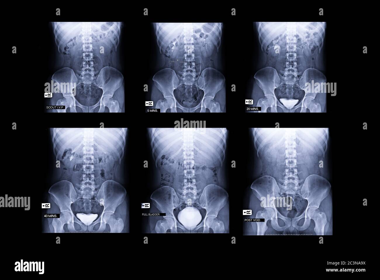procedure of Intravenous pyelogram or I.V.P is an X-ray exam of urinary ...