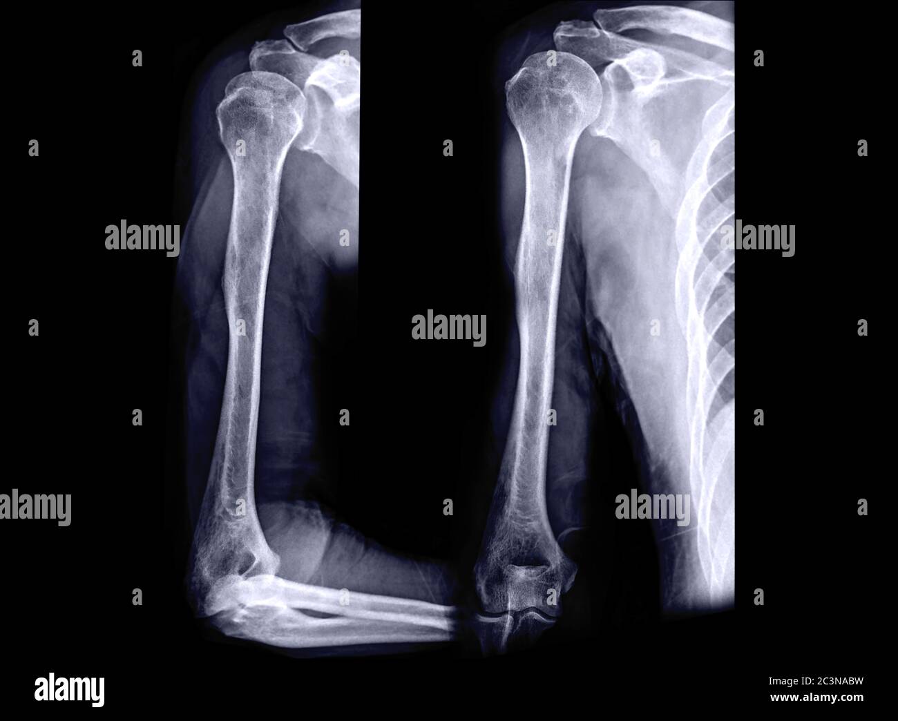 Xray image of Humerus Bone AP and Lateral view . Stock Photo