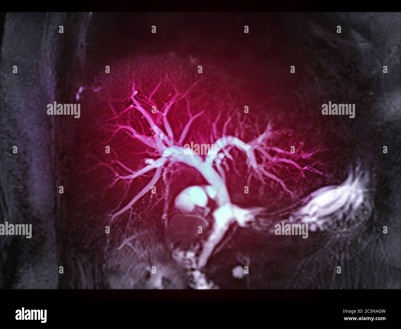 Magnetic resonance cholangiopancreatography or MRCP 3D MIP image showing  visualize the biliary and pancreatic ducts Stock Photo - Alamy