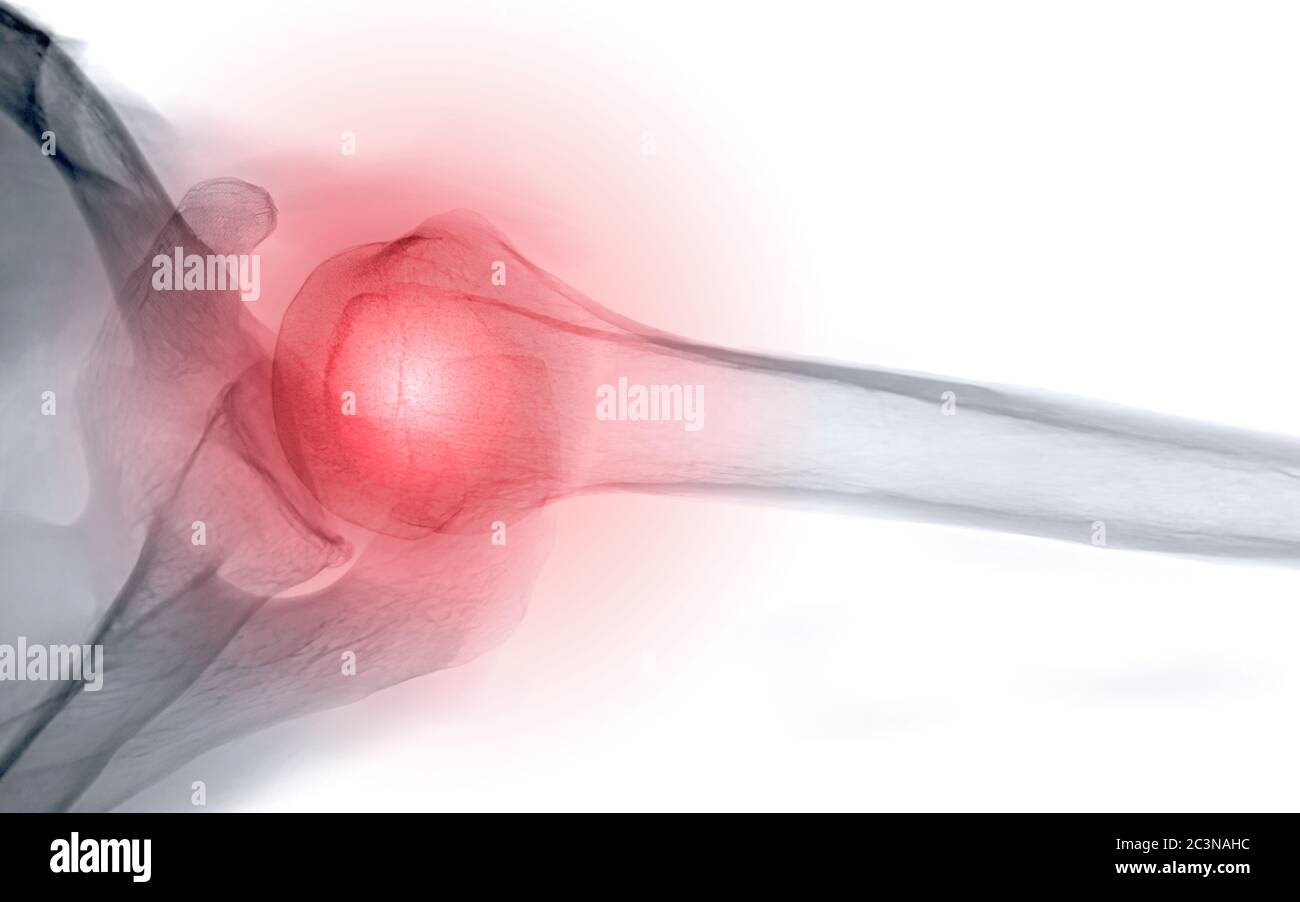Xray Shoulder joint shoulder transaxillary view for diagnosis fracture of shoulder joint Stock