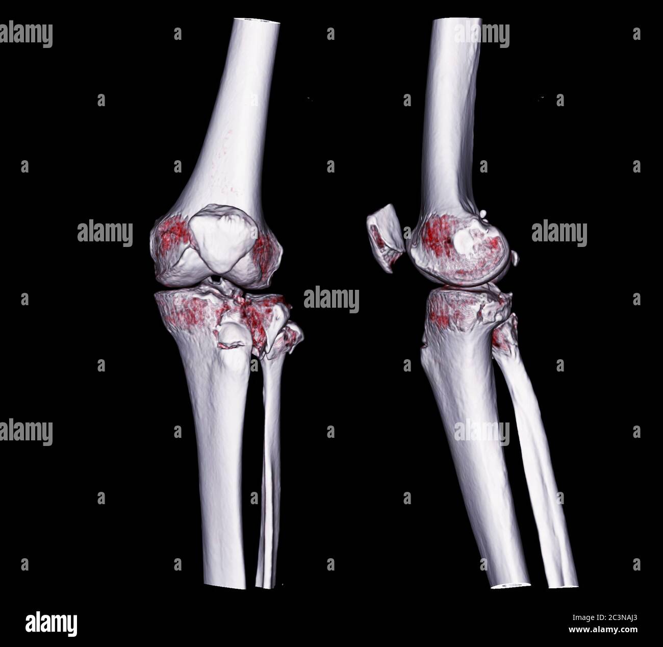 CT knee 3D rendering image AP and Lateral view isolated on black background showing fracture tibia. Stock Photo