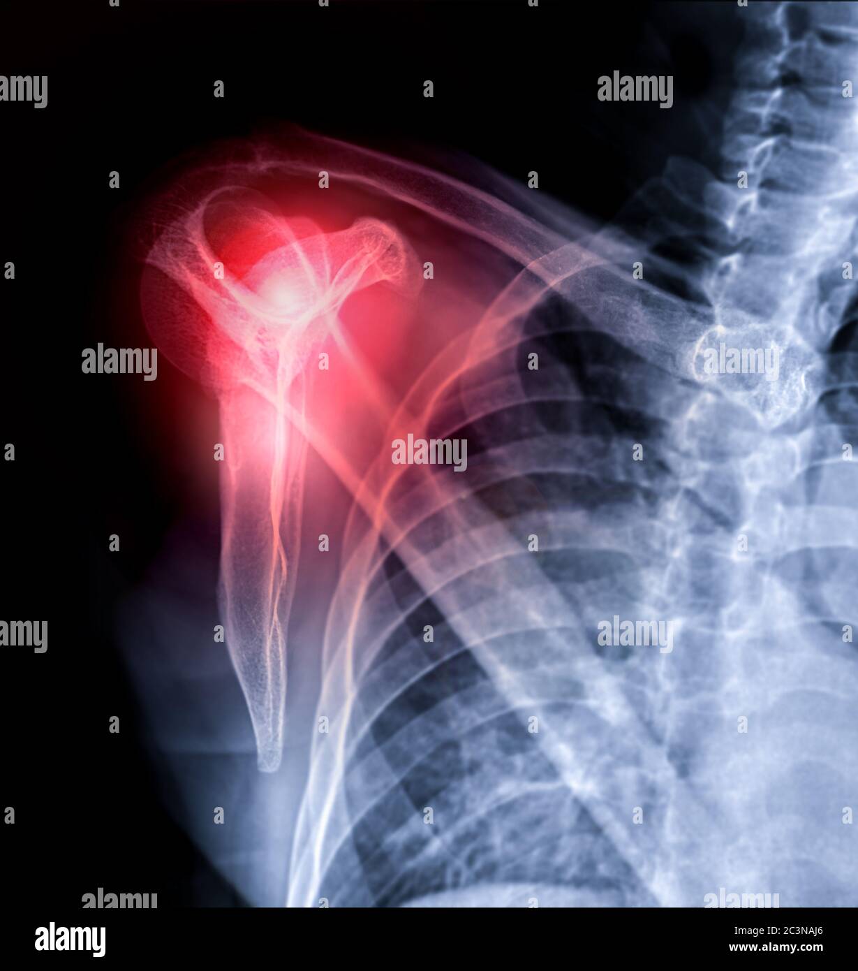 Xray Shoulder joint transcapular view for diagnosis fracture of