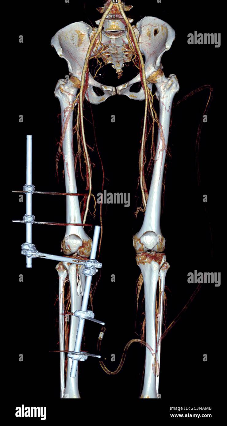 CTA femoral artery run off  3D rendering image  of femoral artery for detect vasucular injury in traumatic patient. Stock Photo