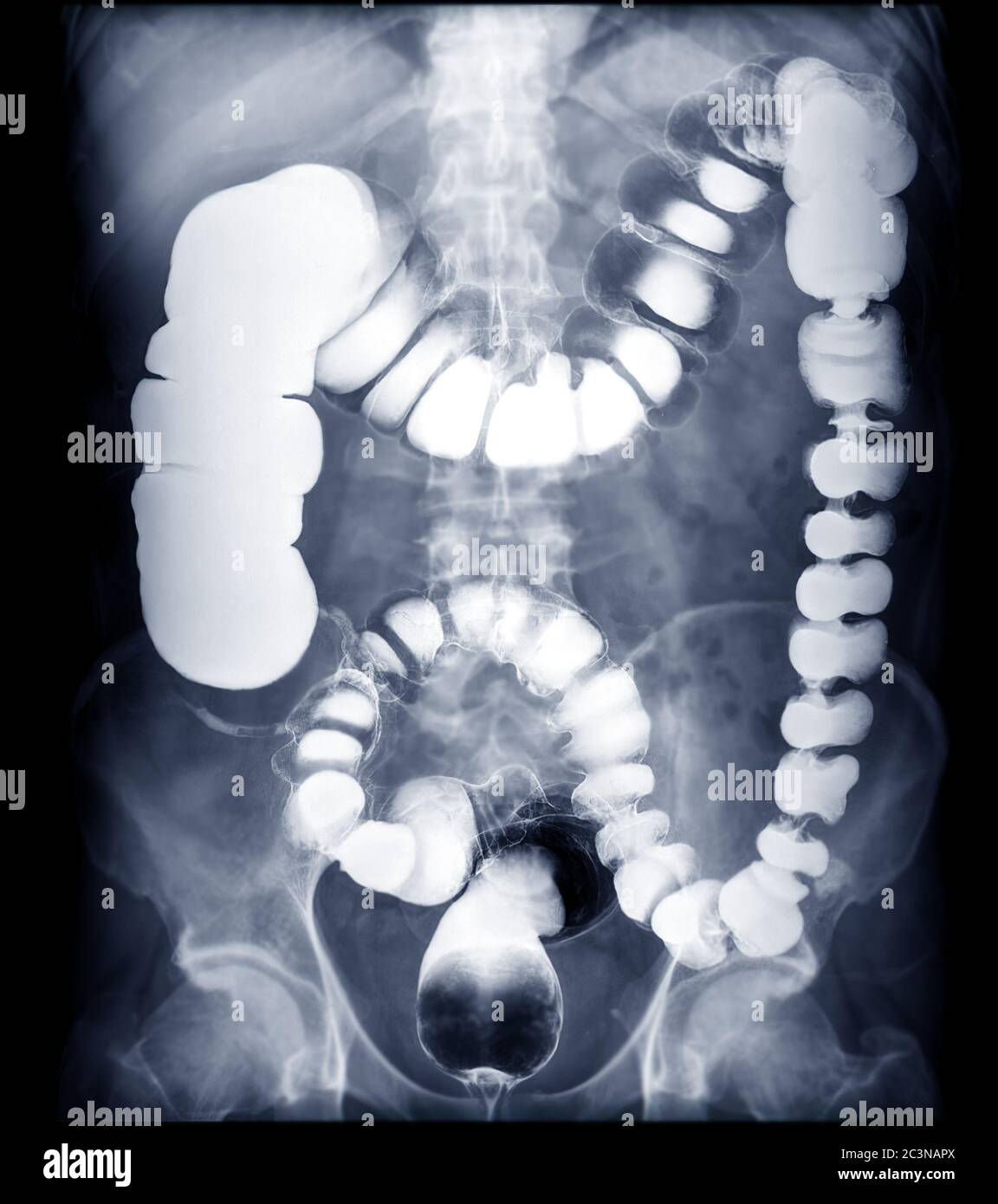 BE or barium enema image or x-ray image of large intestine showing anatomical of colon for detect Colon cancer . Stock Photo